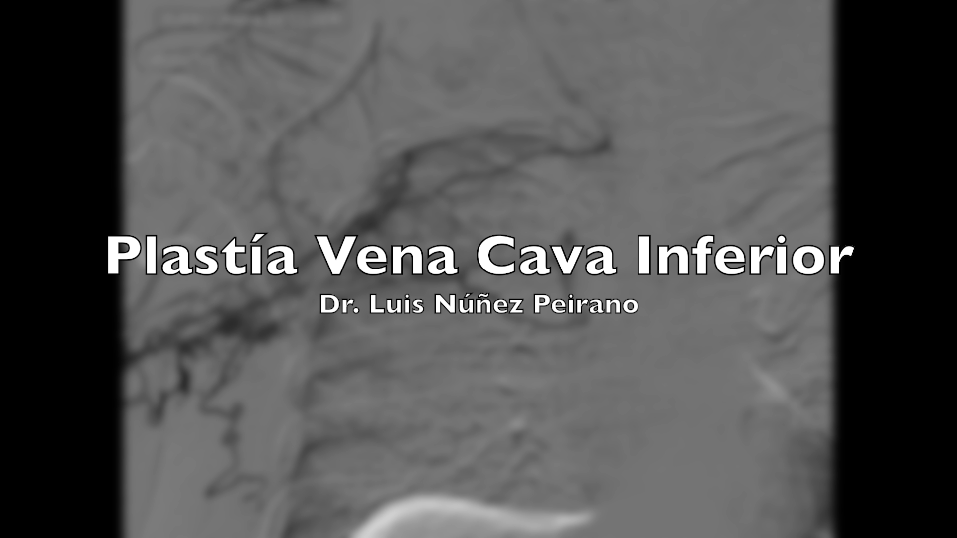 Plastía de la vena cava inferior e instalación de catéter tunelizado femoral